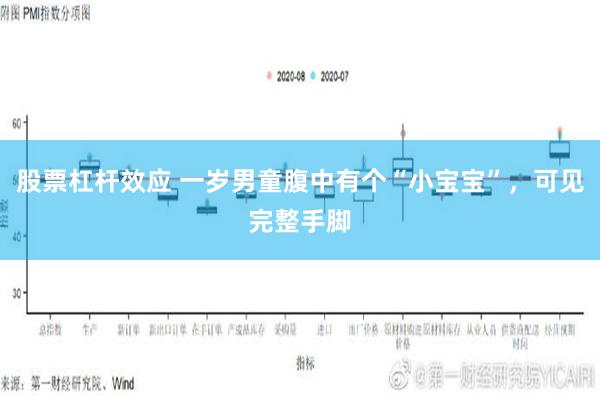 股票杠杆效应 一岁男童腹中有个“小宝宝”，可见完整手脚